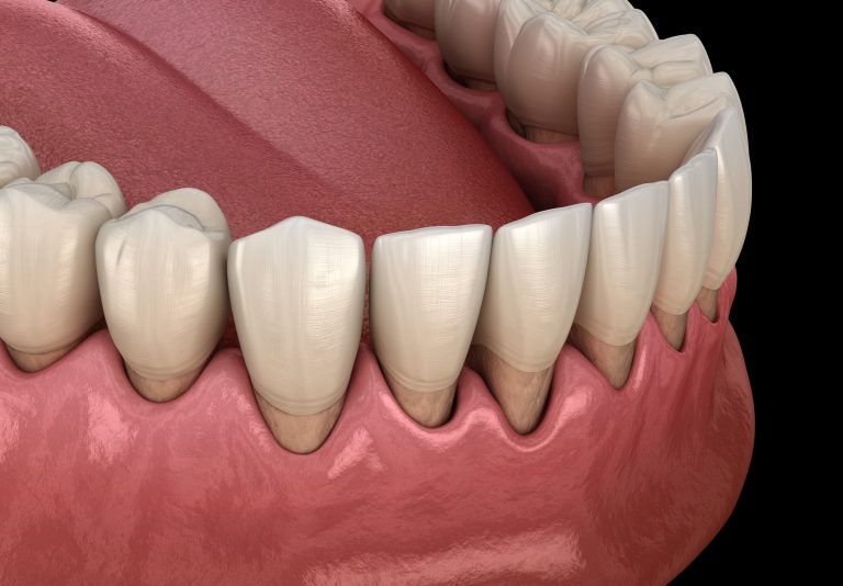 Illustration of a bottom row of teeth showing receding gums in the beginning stage of gum disease and gingivitis