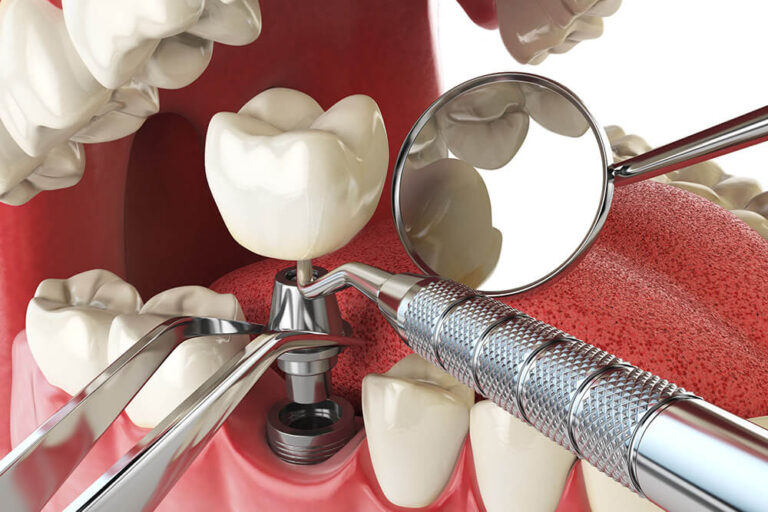 Illustration of a dental implant procedure showing the placement of a crown on the implant post, with dental tools and a mirror reflecting the tooth.