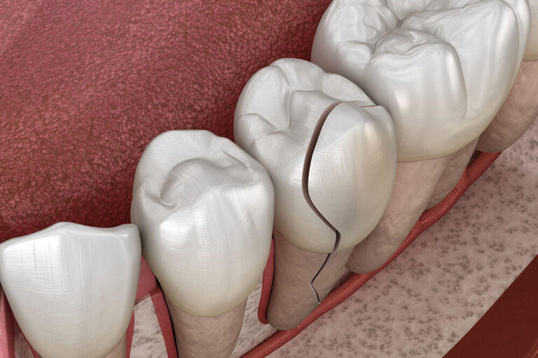 3D illustration of a cracked molar tooth, showing a fracture along the surface of the tooth.