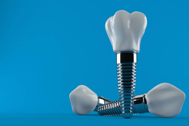 3D rendering of dental implants with metal posts and crowns displayed on a blue background.