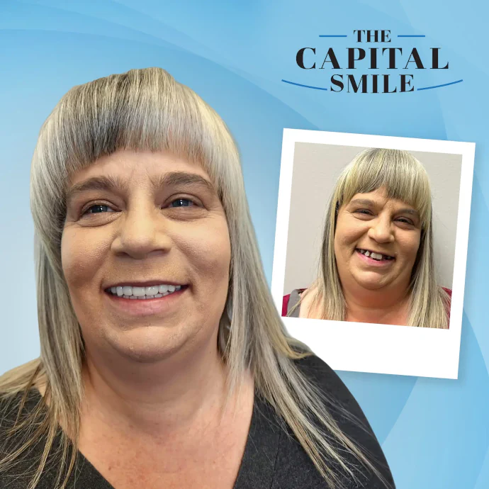 Before and after dental implants in Lincoln, NE at Capital Dental