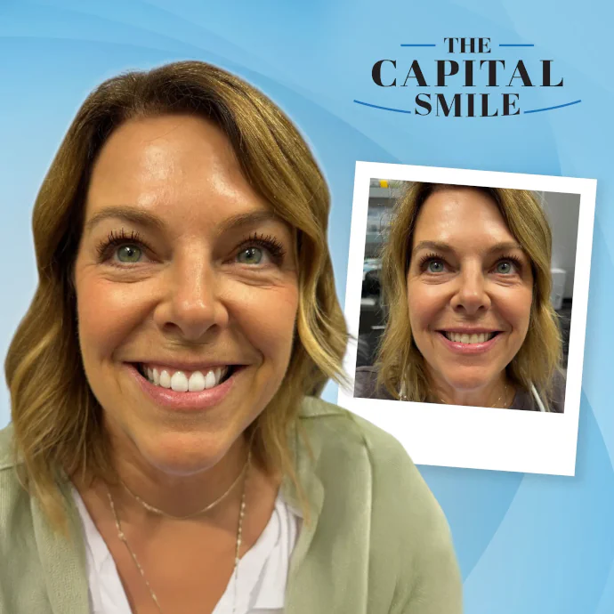 Before and after dental veneers in Lincoln, NE at Capital Dental