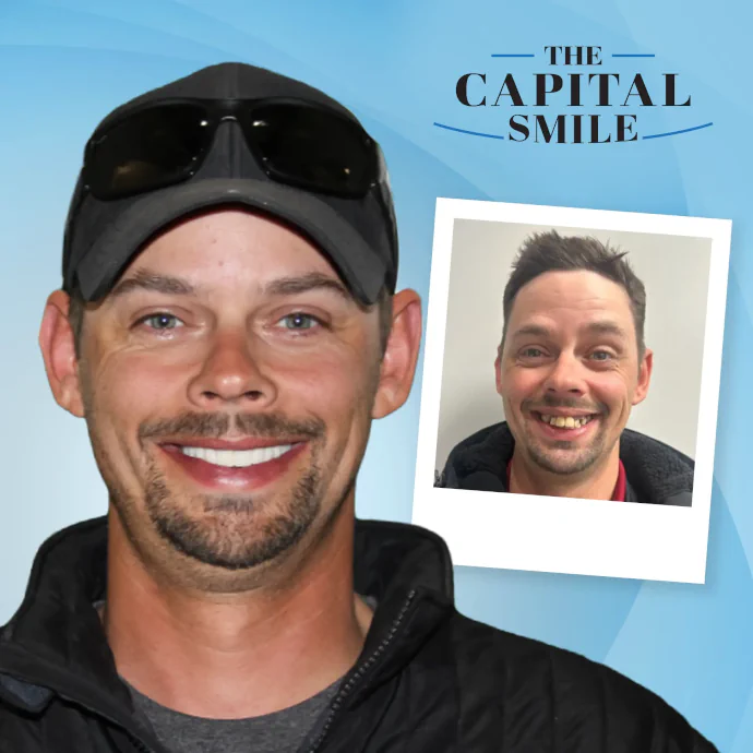 Before and after full-mouth dental implants in Lincoln, NE at Capital Dental