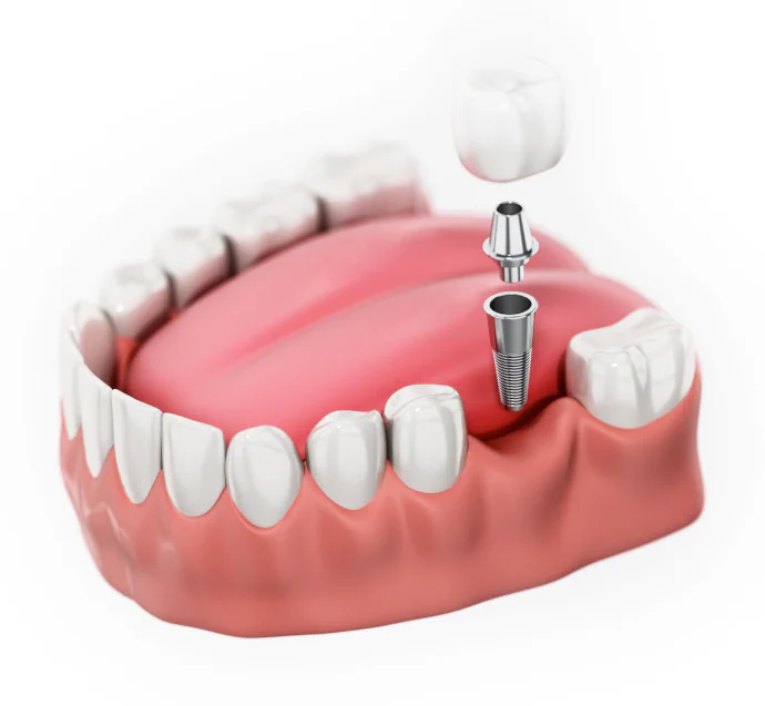 Capital Smiles Dental Implants in Lincoln, NE