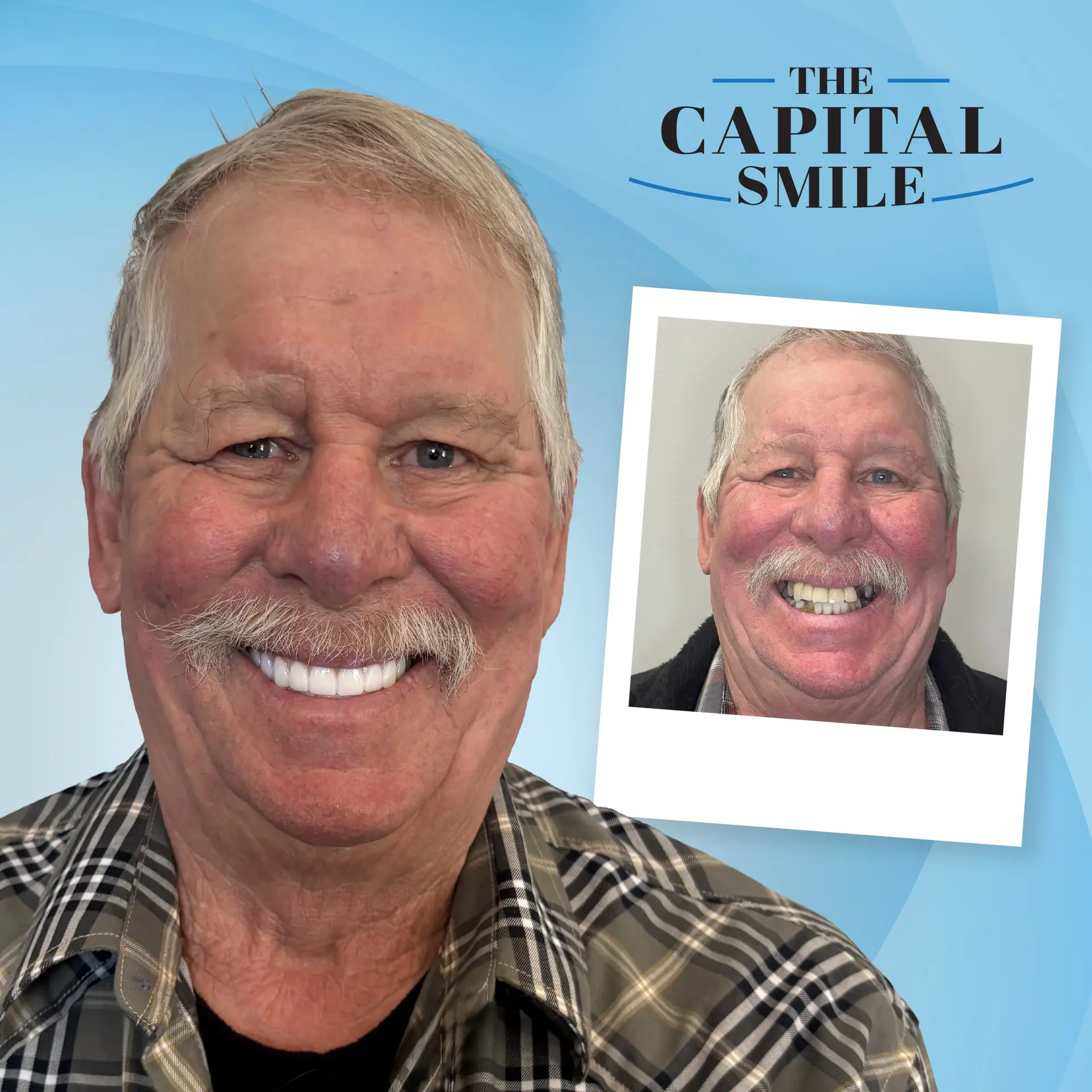 Before and after full-mouth dental implants in Lincoln, NE at Capital Dental