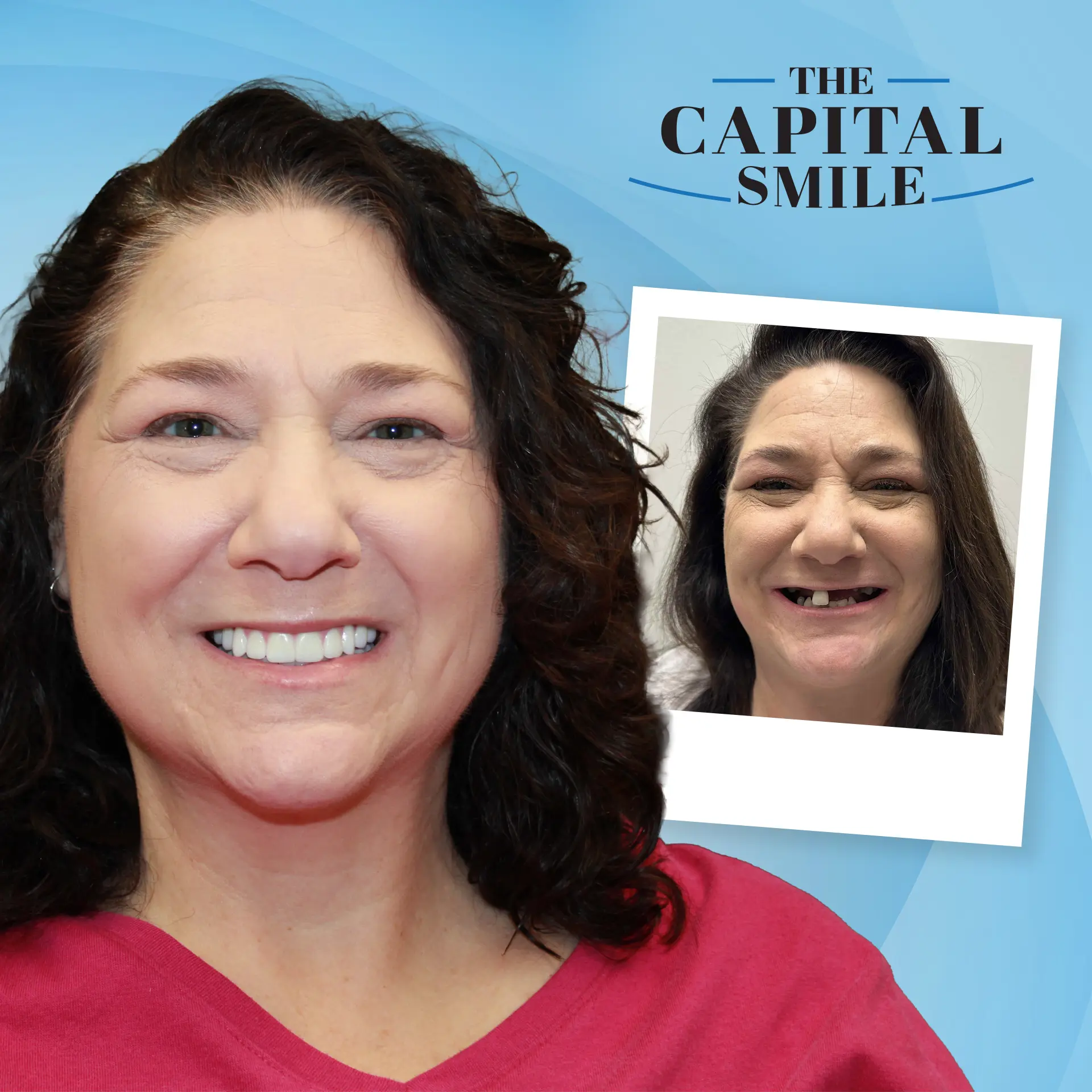 Before and after full-mouth dental implants in Lincoln, NE at Capital Dental