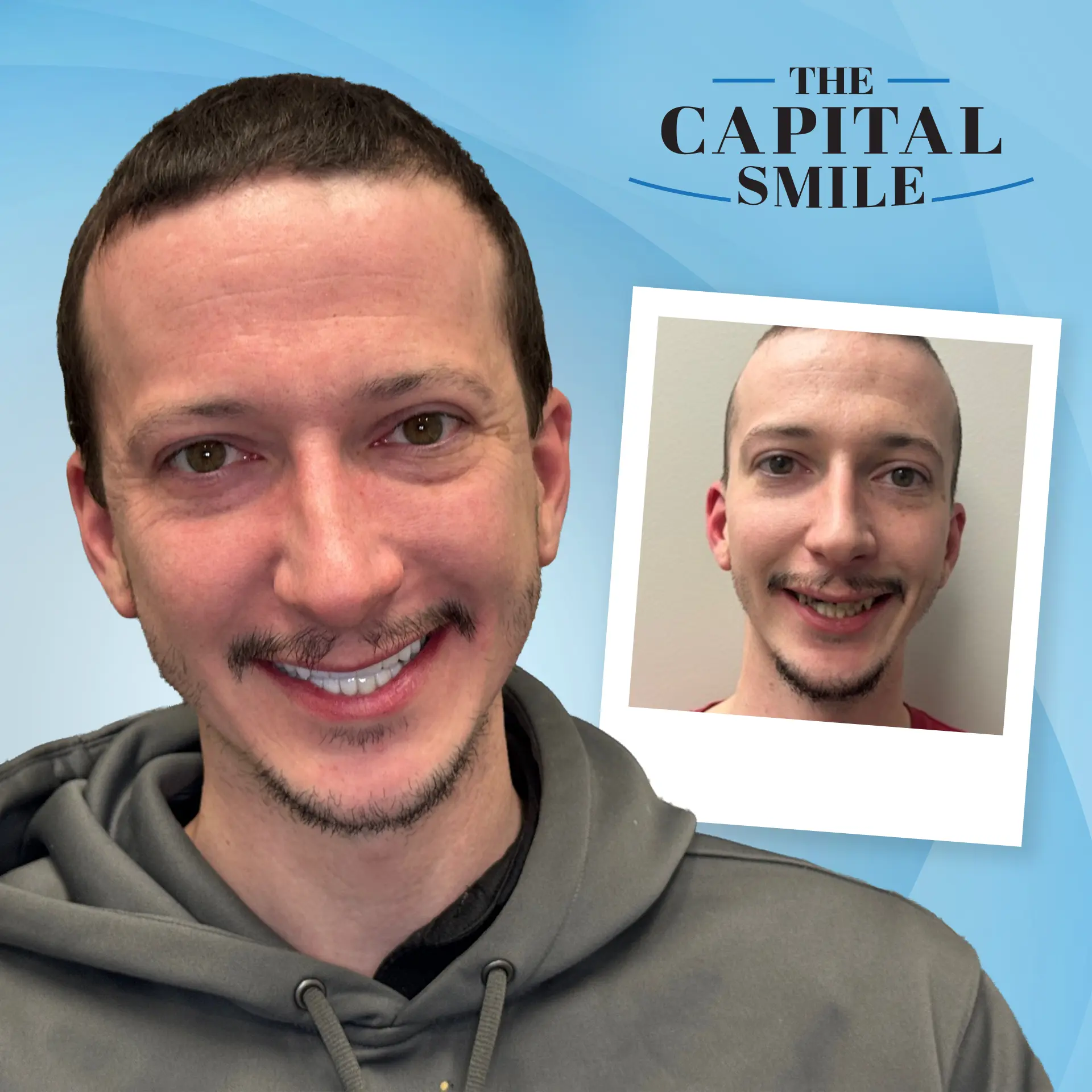 Before and after full-mouth dental implants in Lincoln, NE at Capital Dental