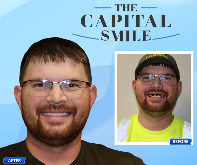 Before-After-Dental-Implants-Capital-Dental-Lincoln-NE-01-690x578 Before & After Dental Implants in Lincoln, NE at Capital Dental