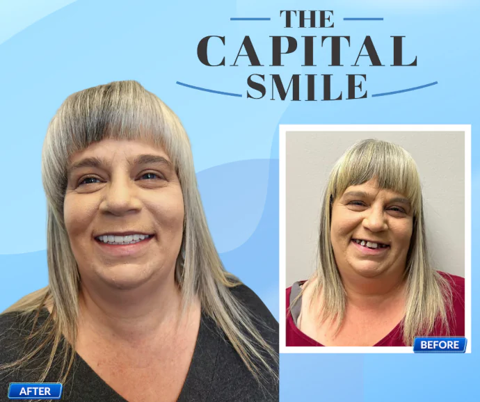 Before-After-Dental-Implants-Capital-Dental-Lincoln-NE-02-690x578 Before & After Dental Implants in Lincoln, NE at Capital Dental