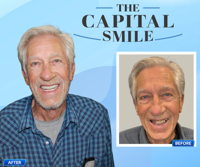 Before-After-Dental-Implants-Capital-Dental-Lincoln-NE-05-690x578 Before & After Dental Implants in Lincoln, NE at Capital Dental