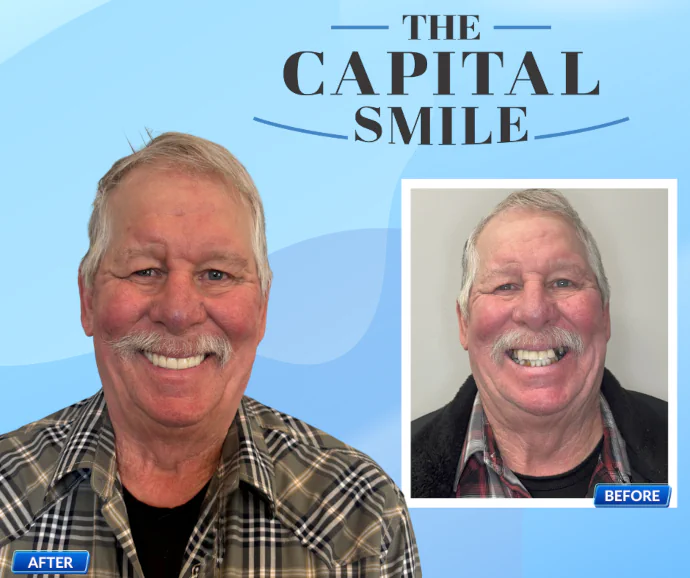 Before-After-Dental-Implants-Capital-Dental-Lincoln-NE-06-690x578 Before & After Dental Implants in Lincoln, NE at Capital Dental