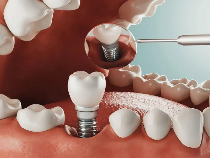 Dental Implants in Lincoln, NE at Capital Dental