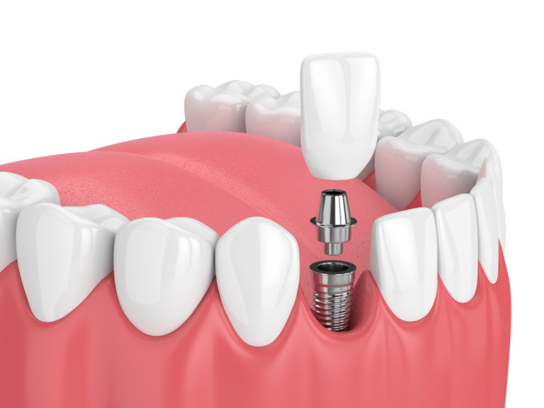 3d rendering of jaw with teeth and dental incisor implant