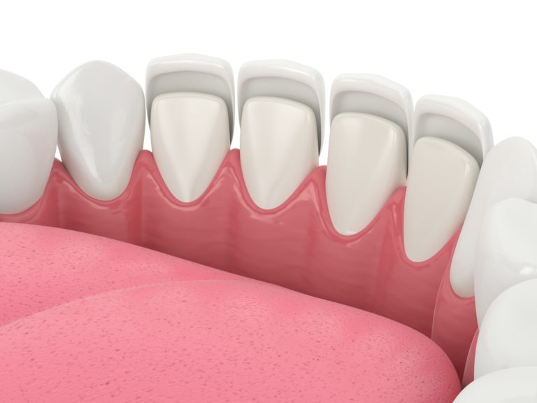 Model of mouth showing teeth with dental veneers to represent capital dental dental veneers services in lincoln nebraska