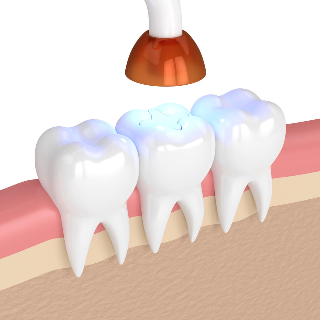 3D illustration of a dental curing light applied to a molar with a freshly placed filling, demonstrating a tooth restoration procedure, with light emitting onto the tooth's surface, set against a neutral background