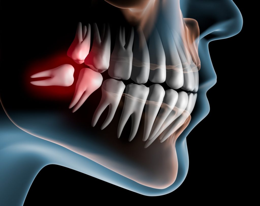 Illustration of a mouth x-ray showing wisdom coming in crooked