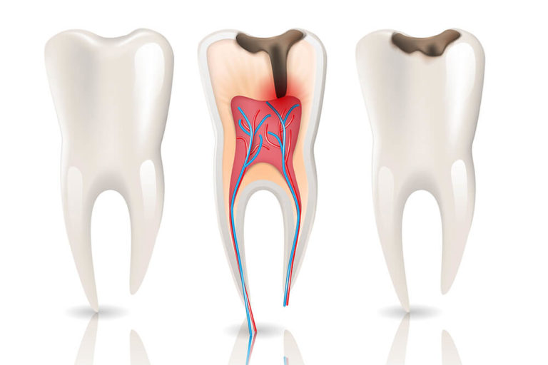 Illustration showing three white teeth in various stages of decay