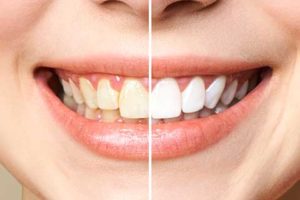 before and after of teeth whitening 