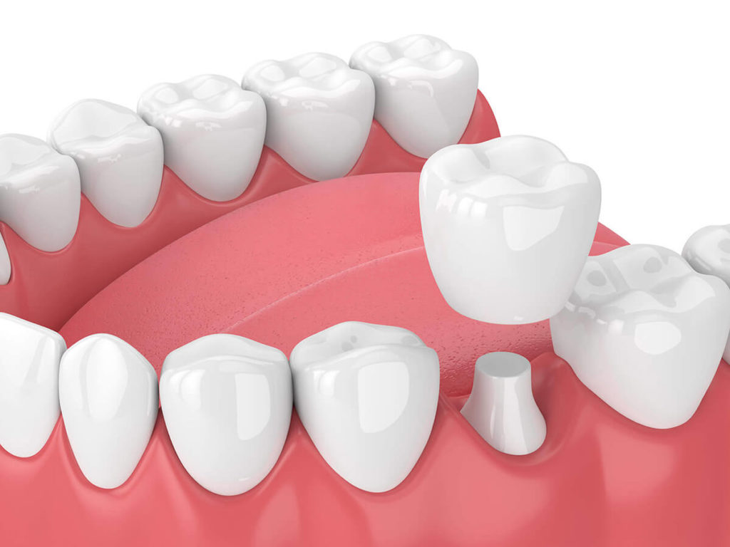 Illustration of a dental crown being added to a row of teeth