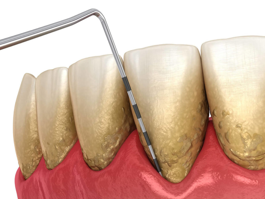 Illustration of periodontal/gum disease progress being checked on a row of teeth with plaque on them