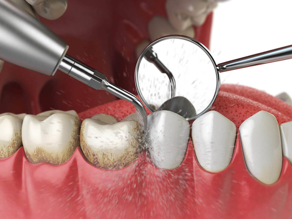 Illustration of teeth cleaning with dental tools