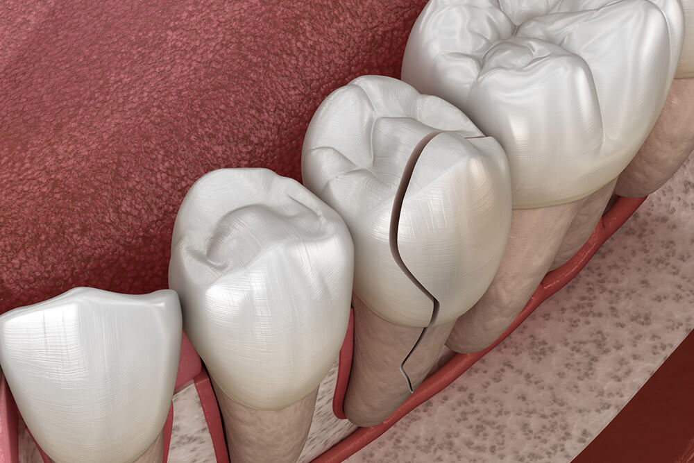 How to Know If Your Tooth’s Enamel Is Damaged Capital Dental