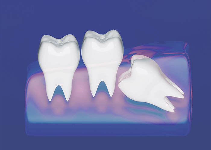 illustration of back molars with the last being an impacted wisdom tooth